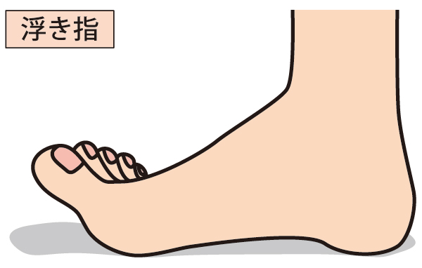 横から見た浮指